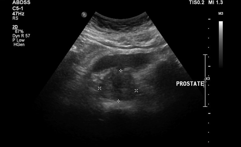 Ultradźwiękowe zapalenie prostaty przed przyjmowaniem Urosaf