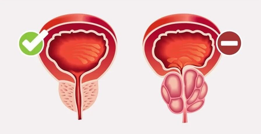 Zapalenie prostaty u mężczyzn