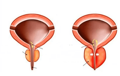 Co to jest ostre zapalenie prostaty
