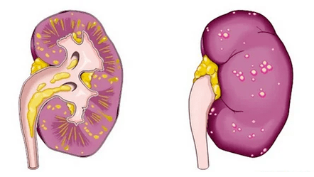 Do czego prowadzi ostre zapalenie prostaty