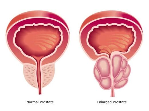 Normalna i powiększona prostata