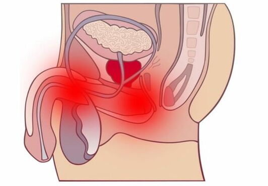 Ostre zapalenie prostaty